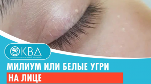 ? Милиум или белые угри на лице. Клинический случай №823