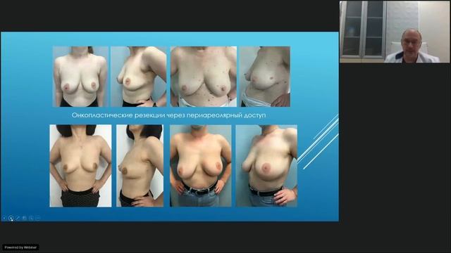 Рак молочной железы (вебинар 14 мая 2021) смотреть онлайн