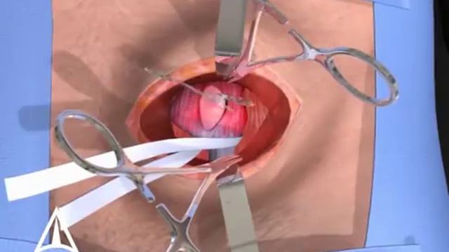 Inguinal hernia surgery - 3D animation смотреть онлайн