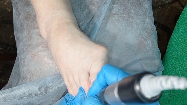 Педикюр/Аппаратный педикюр/Гиперкератоз/Стержневая мозоль/Трещины на пятках/ смотреть онлайн