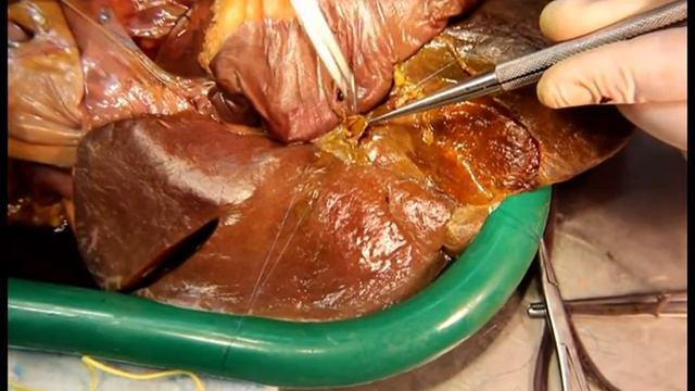 Hepaticoenterostomy (Бигепатикоеюноанастомоз)