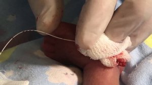 Постановка центрального венозного катетера Виволайн недоношенному новорожденному ребенка