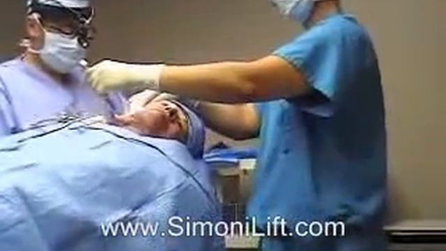 Simoni Lift, The Face Lift Of The Future: S-lift Facelift With Local Anesthesia, Patients Stay Awak
