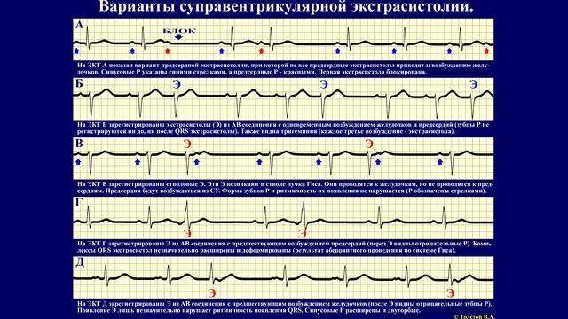 Тема 26.1. Экстрасистолия и суправентрикулярные аритмии. смотреть онлайн