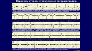 Тема 26.1. Экстрасистолия и суправентрикулярные аритмии.