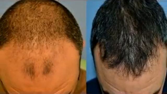 Присаждане на коса с д-р Банковска в предаването "Супер доктор" на телевизия "България он Ер. смотреть онлайн
