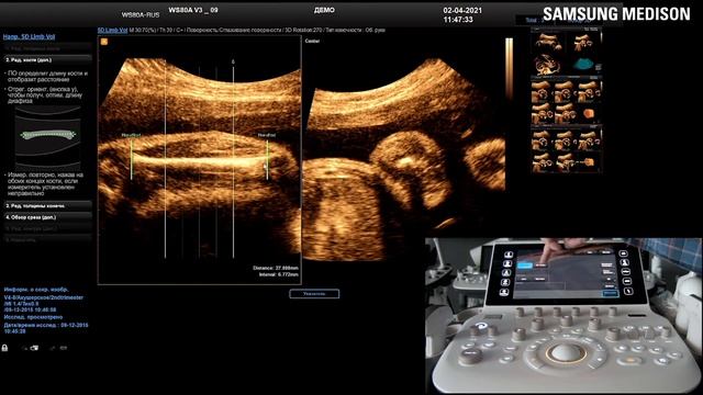 Работа с режимом 5D Limb Vol на УЗ Сканере Samsung Medison WS80 смотреть онлайн