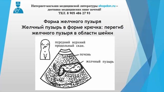 УЗИ. Желчный пузырь в форме крючка перегиб желчного пузыря в области шейки. Журнал "МедДон". смотреть онлайн