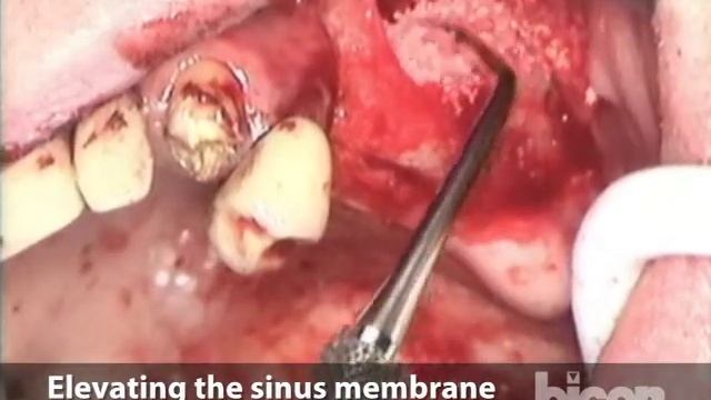 Lateral Sinus Lift using SynthoGraft™ смотреть онлайн