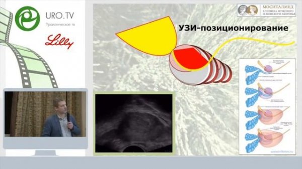 Биопсия простаты.mp4