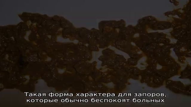 Форма кала при геморрое смотреть онлайн