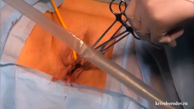 Имплантация субуретрального проленового слинга в лечении стрессового недержания мочи у женщин смотреть онлайн