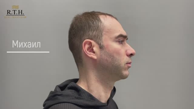 Повторная блефаропластика: результат спустя 6 дней.