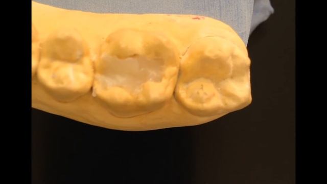 Реставрация зуба , силиконовым ключем .пломба на зуб.