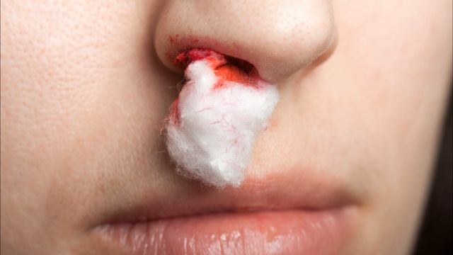 Почему идет кровь из носа? Что можно, и что нельзя при этом делать?
