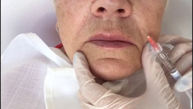 Коррекция носогубных складок