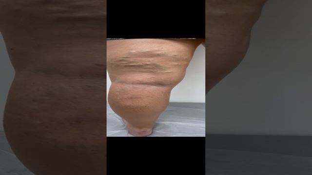 Варикозные Вены. Варикозная болезнь. Варикоз на ногах. Тазовый варикоз. Флеболог Москва. Флеболог