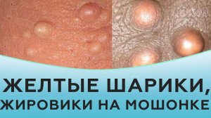 Желтые шарики, жировики на мошонке.