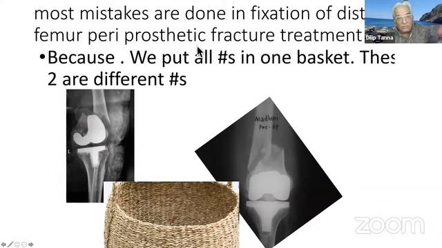 MOA Masterclass : Talks & Case based Interactive series : Redo Surgery of Distal Femur Fractures смотреть онлайн