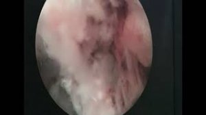 Эндоскопическое удаление грыжи диска в SL