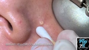 Your new favorite extraction video part 1. Blackheads, whiteheads, milia. Over 20 minutes of pops.