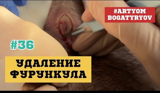 36. Удаление ФУРУНКУЛА ЧБД