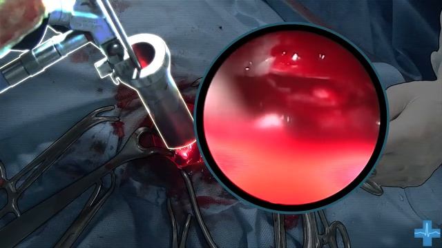 Удаление новообразования головного мозга смотреть онлайн