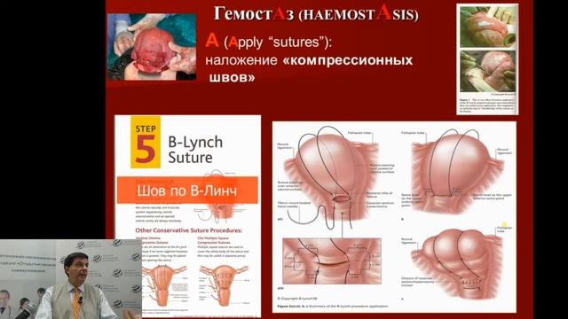Профилактика патологичеcкой кровопотери при кесаревом сечении смотреть онлайн