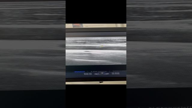 Формирование бляшк в сонной артерии. Атеросклероз. Узи сосудов. Флеболог. Флнболог Москва смотреть онлайн