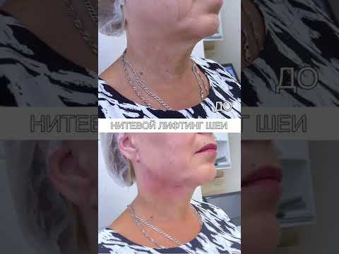Нитевой #лифтинг шеи #допосле смотреть онлайн