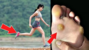 Этот способ избавил не один миллион людей от натоптышей. Народные способы от натоптышей на ногах.