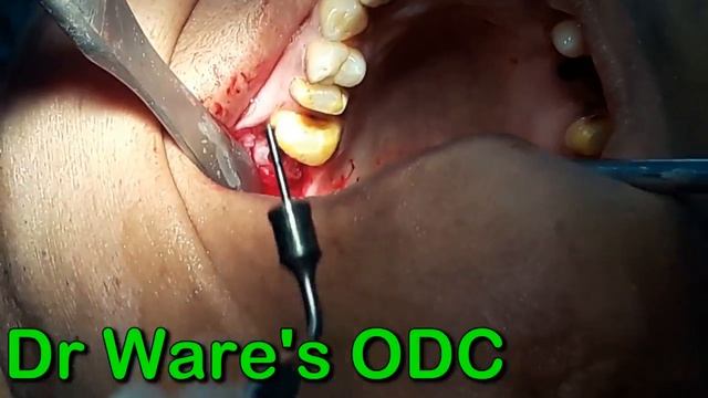 Maxillary sinus lift ( Crestal approach ) and implant placed with 17 смотреть онлайн