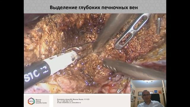 Лапароскопические и открытые резекции печени