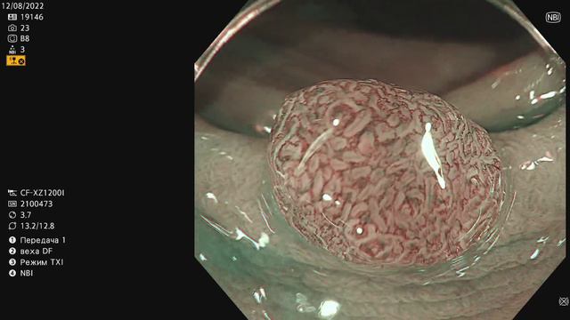 Tubular adenoma of colon смотреть онлайн