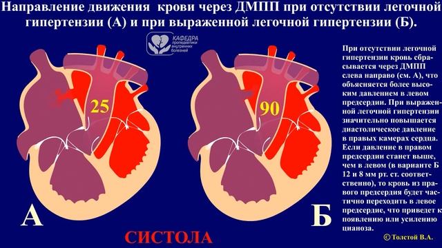 ВПС. Дефект межпредсердной перегородки. смотреть онлайн