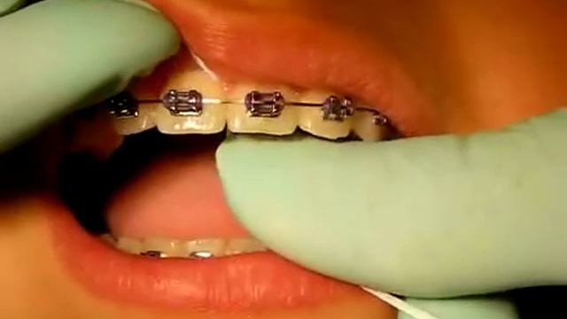 Bracesquestions.com - Flossing With Braces, How to Floss Teeth смотреть онлайн