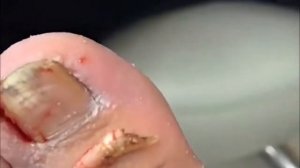Удаление болезненного инфицированного ногтя на ноге
