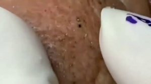 Удаление чёрных точек на лице?