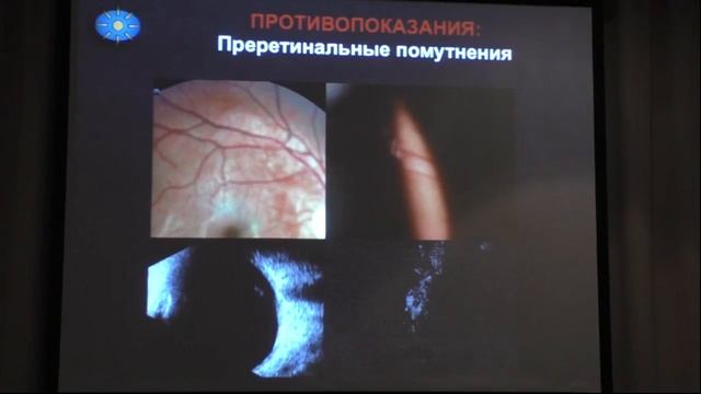 Лазерный витреолизис плавающих помутнений стекловидного тела. смотреть онлайн