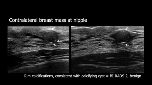 Improving Specificity of Breast Ultrasound: BI-RADS 3 and 4A