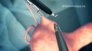 Миома матки. Хирургическое лечение.mp4