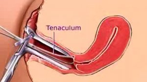 3D моделированное руководство по биопсии эндометрия - часть вторая