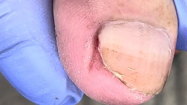 Clean up the dirt under the ingrown nails!【Xue Yidao】 смотреть онлайн
