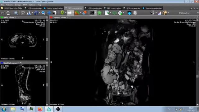 А ТАК ЛИ НЕОБХОДИМО ВВЕДЕНИЕ КОНТРАСТА , ПРИ МРТ ОБСЛЕДОВАНИЯХ ? смотреть онлайн