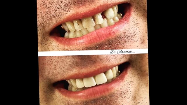 ? Нашему пациенту 42 года и он выбрал эстетику? Диоксид циркониевые коронки ? смотреть онлайн