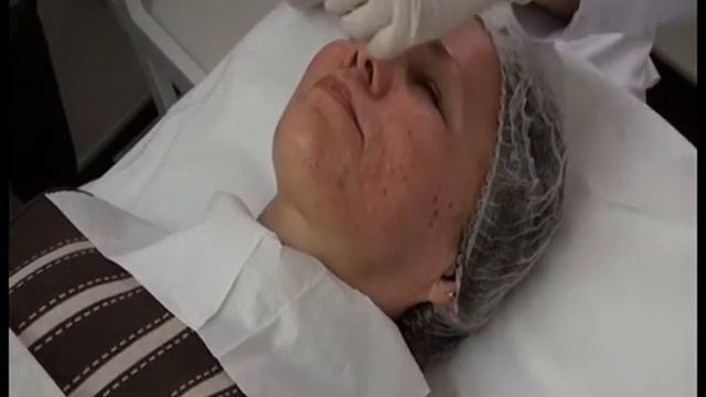 Биоревитализация - приподнимать кожу необходимо для удобства