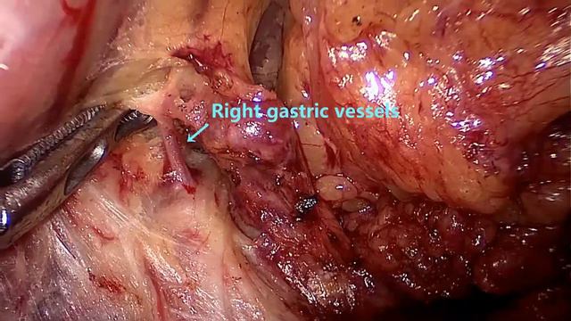Asvide: Delta-shaped Billroth-I anastomosis following laparoscopic distal gastrectomy was performed смотреть онлайн