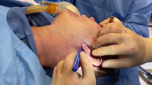 UNBOTCHED Ep. 23: The Anti-Aging Facelift смотреть онлайн