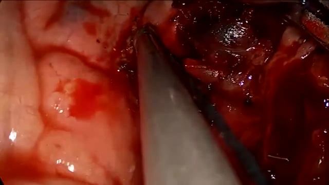 Asvide: Left upper lobectomy and systematic lymph nodes dissection in enlarged pulmonary hilar... смотреть онлайн