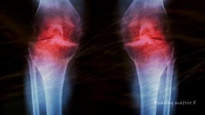 Matrix Garyaeva for the treatment of knees
